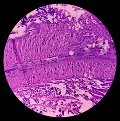 Swelling of middle finger (biopsy). Lobular Capillary hemangioma. A benign neoplasm of increased number of vessels with RBC lined by endothelial cells. Benign vascular proliferations.
