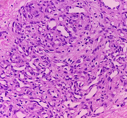 Swelling of middle finger (biopsy). Lobular Capillary hemangioma. A benign neoplasm of increased...