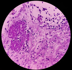 Pleural tissue (biopsy): Section show fibro collagenous tissue. focal area of atypical looking...