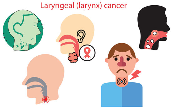 laryngeal (larynx) cancer,Human organ concept. Malignant neoplasm. Sign for web page, Sore loss cough virus viral acute swell sound folds treat cysts Palsy nerve Tumor botox throat hoarse,vectors