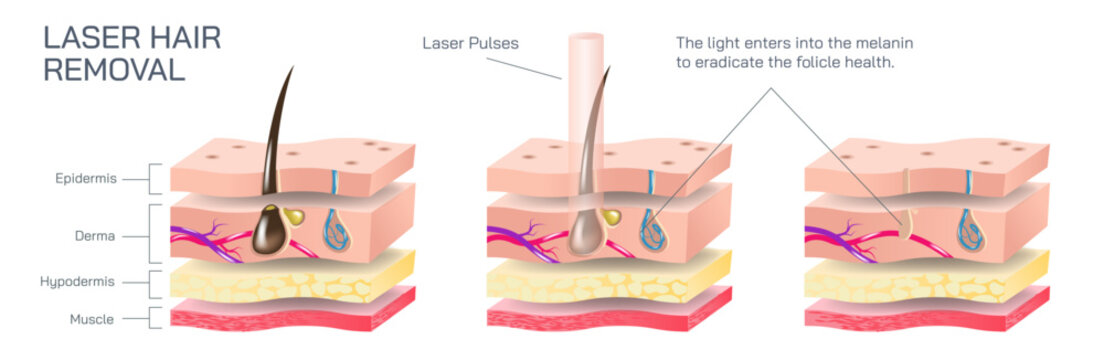 Laser hair removal is a procedure that uses a laser, or a concentrated beam of light on the skin to get rid of hair in the body vector illustration. Skin layers and how laser affects the body hair.