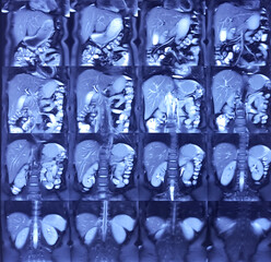 MRCP film of MRI of abdomen. Tiny granular calculi, hepaticolithiasis. Liver, bile duct, pancreas duct for medical health diagnosis.