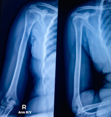 X-ray image of shoulder joint and arm both view. Normal skeletal. Medical image concept.