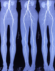 CT angiogram (CTA) shown the abdominal aorta, kidney and common iliac artery. Calcified plaques in...