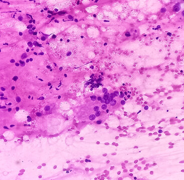 FNA cytology of swelling of chest wall. Infected epidermal inclusion cyst. Commonly called "sebaceous cyst". Smears show anucleated squames admixed with plenty of polymorphs, lymphocytes, histiocytes.