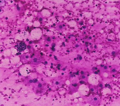 FNA cytology of swelling of chest wall. Infected epidermal inclusion cyst. Commonly called "sebaceous cyst". Smears show anucleated squames admixed with plenty of polymorphs, lymphocytes, histiocytes.