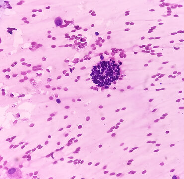 FNA cytology of swelling of chest wall. Infected epidermal inclusion cyst. Commonly called "sebaceous cyst". Smears show anucleated squames admixed with plenty of polymorphs, lymphocytes, histiocytes.