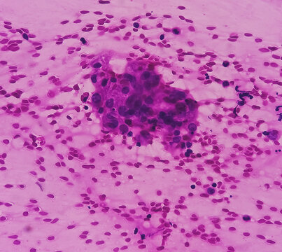 FNA cytology of swelling of chest wall. Infected epidermal inclusion cyst. Commonly called "sebaceous cyst". Smears show anucleated squames admixed with plenty of polymorphs, lymphocytes, histiocytes.