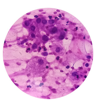 FNA cytology of swelling of chest wall. Infected epidermal inclusion cyst. Commonly called "sebaceous cyst". Smears show anucleated squames admixed with plenty of polymorphs, lymphocytes, histiocytes.