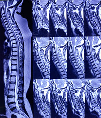 MRI of Cervical Spine and screening. Cervical spondyloarthropathy, thecal sac indentation at C4-C5...