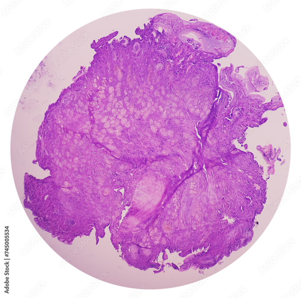 Sticker Photo of benign brenner tumor of ovary, showing tumor sheet on the right side and ovarian stroma on the right side.