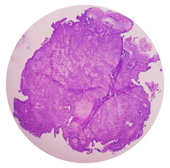 Photo of benign brenner tumor of ovary, showing tumor sheet on the right side and ovarian stroma on...