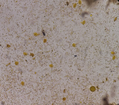 Giardia lamblia cysts and Trophozoite form, muscle fiber in stool examination, under 40X light microscope, selective focus.