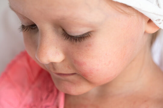 coxsackievirus, Singapore flu, skin rashes, blisters, viral infection, disease