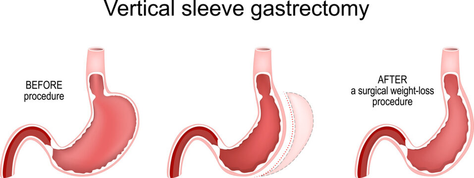Vertical Sleeve Gastrectomy. Stomach before and after a surgical weight-loss procedure