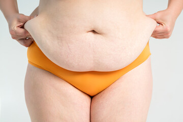 Tummy tuck, flabby skin with stretch marks on a fat belly, plastic surgery concept on gray background - 745106303
