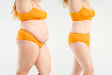 Tummy tuck, woman's fat body before and after weight loss and liposuction on gray background, plastic surgery concept - obrazy, fototapety, plakaty
