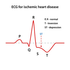 Diagram of the ECG for coronary heart disease. Heart cardiogram. Vector illustration in flat style