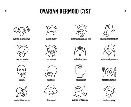 Ovarian Dermoid Cyst symptoms, diagnostic and treatment vector icons. Line editable medical icons.