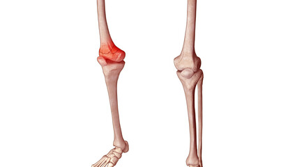 3d Medical Illustration of a Lower Femur Fracture on Male Body Skeleton - obrazy, fototapety, plakaty