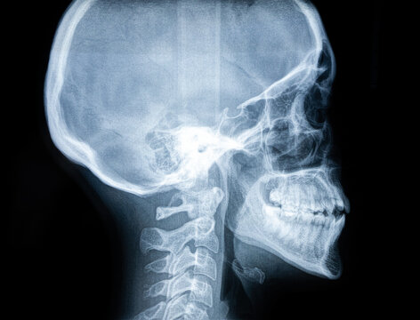 X ray picture of a female scull and jaw with teeth