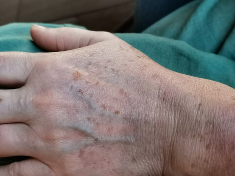 Woman's hand close up. Skin covered with pigment spots