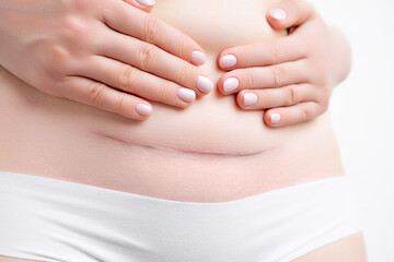 Woman holding her belly and demonstrates hypertrophic scar after c section. 