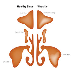 Healthy Sinus Sinusitis Science Design Vector Illustration Diagram