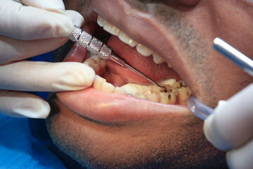 Removal of caries with a spoon in a molar. Dental concept