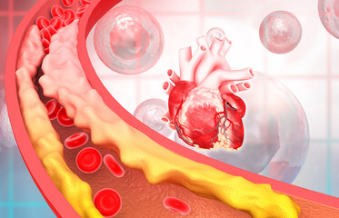 Cholesterol in human heart, Clogged blood vessels,3d illustration.