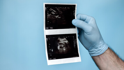 Urologist doctor analyzes an ultrasound of a person's kidney, a stone or calculus in the kidney on an ultrasound. Male urinary tract disease.