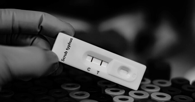 Blood sample of patient positive tested for scrub typhus by rapid diagnostic test.