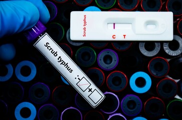 Fototapeta premium Blood sample of patient negative tested for scrub typhus by rapid diagnostic test.