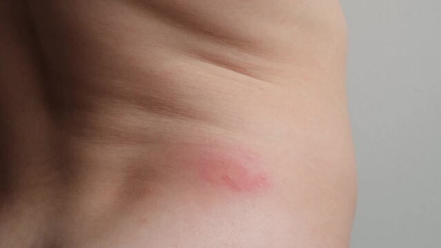 Concept of allergic reaction by mosquito bites. Back of child with irritated swollen skin from insect bite. Body care