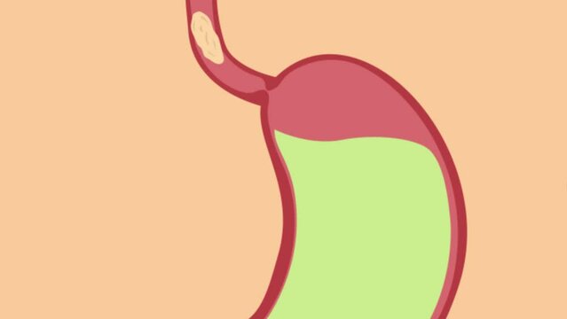 Stomach Acid Relux. Esophagus, gerd. Pain In The Digestive System, Gastritis, pyrosis, Acid Reflux Disease GERD, 2D animation