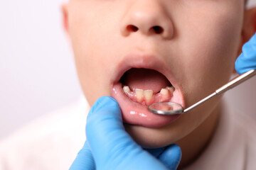 The oral cavity of a boy with missing baby teeth is examined using a dental mirror. Dentistry and dental care.