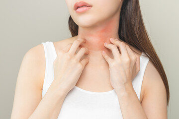 Dermatology concept, asian young woman, girl allergy, allergic reaction from atopic, insect bites on her neck, hand in scratching itchy, itch red spot or rash of skin. Health care, treatment of beauty - obrazy, fototapety, plakaty