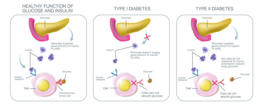 Difference between type one diabetes and type two diabetes. Where body cell do not absorb glucose to balance the insulin level vector illustration. Diabetes mellitus. Diabetes symptoms and prevention.