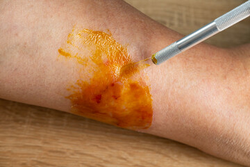 doctor treats large healing wound from on lower leg with scars of adult patient, inflammation and...