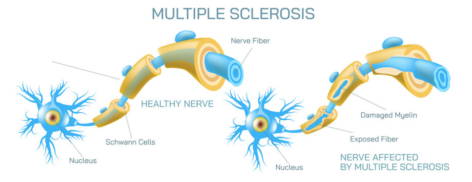 how neurotransmitter works? The process the brain neurons communicate each other anatomy vector illustration. Action potentials and synapses. multiple sclerosis formation. Motor neuron communication.