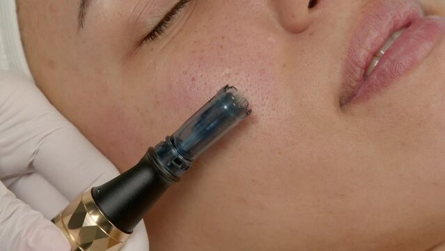 Close -up of black woman at fractional mesotherapy procedure with micro needling device in cosmetology clinic