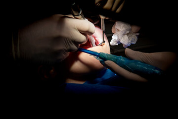 dentist while he is treating a caries to a patient