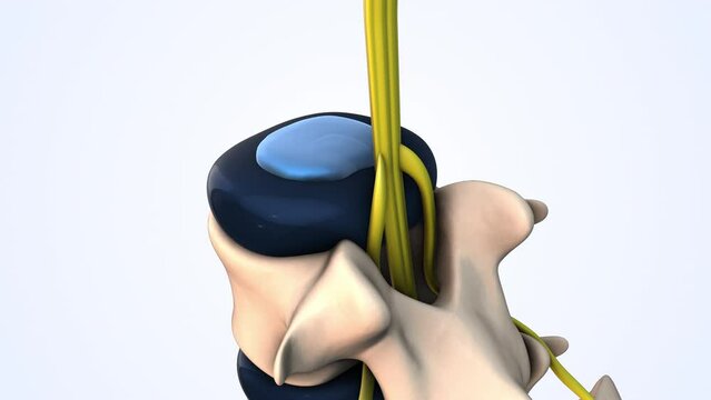 Lumbar spine herniated disc medical animation