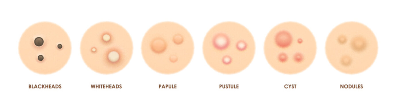 Body skin acne types, pimples and papules, pore inflammation and problems, vector icons. Face skin acne types, blackhead, pustule or whitehead, papule and cyst with nodules for skincare cosmetology