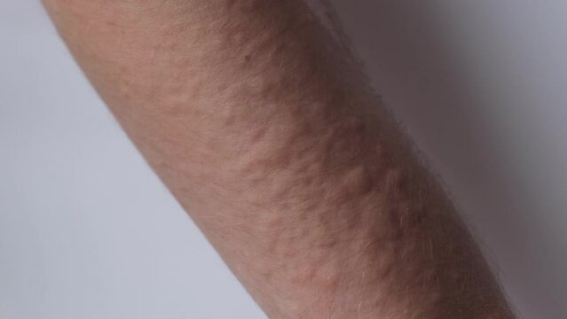 Rash on the arm, urticaria, allergies, skin diseases of a large clan. Papules, pimples.
