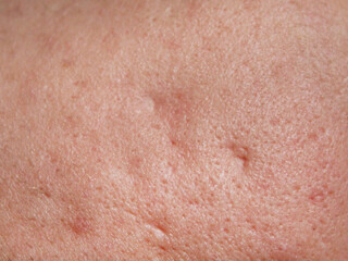 Fototapeta premium Texture of porous skin with traces of pimples and acne. Problem skin treatment concept. High quality stock photo.