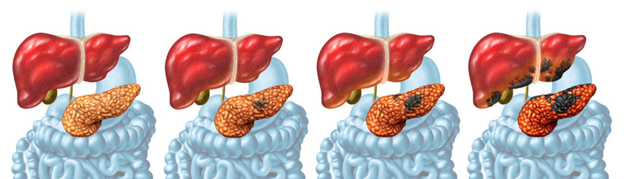 Pancreatic Cancer Stages concept and Pancreas disease as malignant tumor growth stage as a digestive gland with cancerous cells dividing and spreading to other organs.