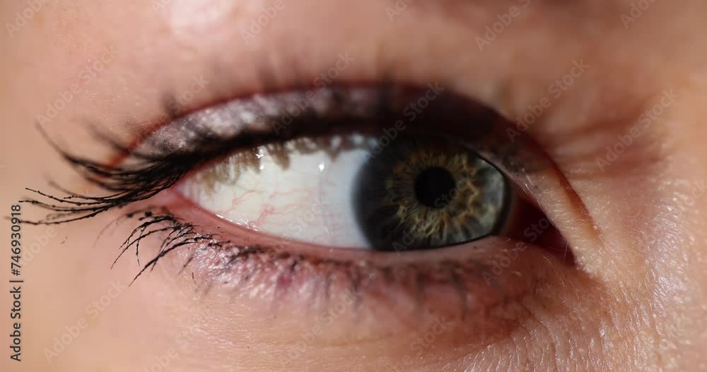 Wall mural closeup of a woman eye with visible bloodshot veins and watery eyelid and soft contact lens