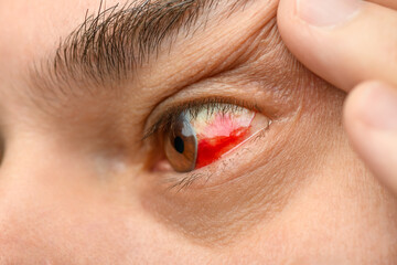 a human eye with a burst vessel and blood leaking into the eyeball, hemorrhage, a close view of a...