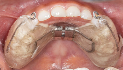 Palatal expander device sealed to widen the upper jaw in orthodontics treatment. Transparent...